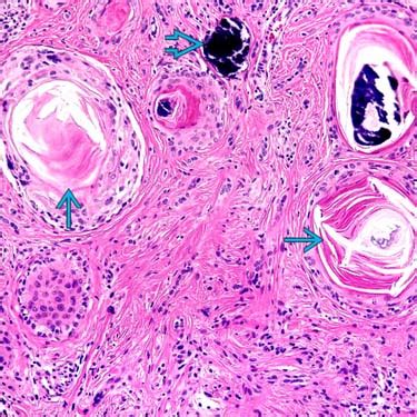 Trichoepithelioma | Basicmedical Key