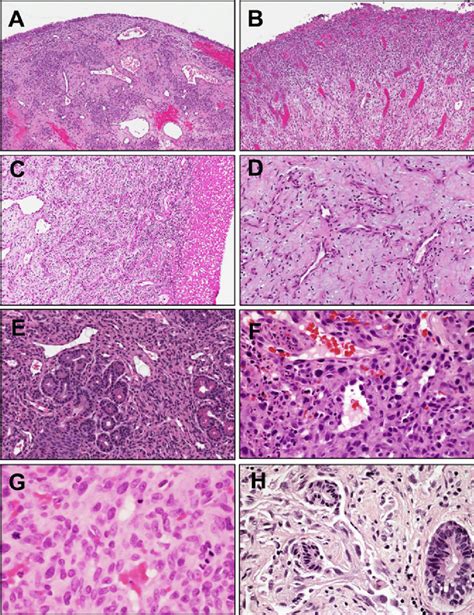 a Lobular capillary hemangioma (LCH) demonstrates distinctive... | Download Scientific Diagram