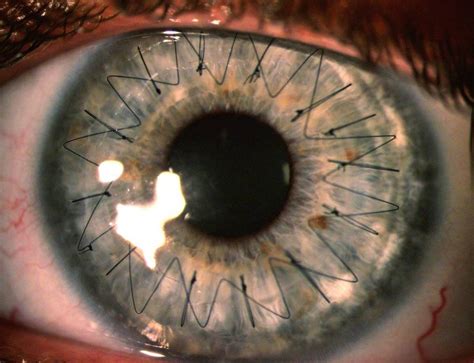 What Happens During Cataract Surgery Corneaaz