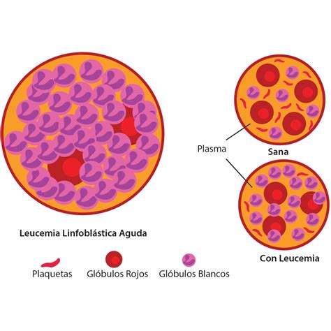 2 Qué es la Leucemia Linfoblástica Aguda AEAL