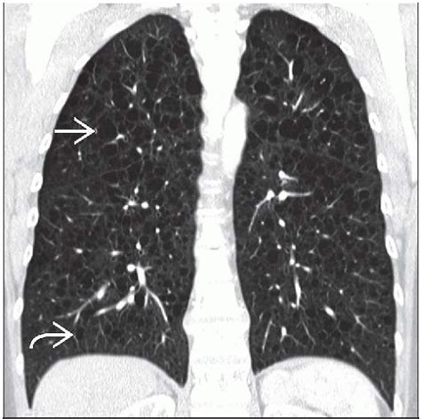 Lymphangioleiomyomatosis Radiology Key