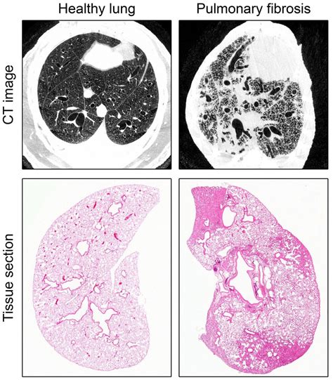 Researchers Identify Key Mechanisms Involved In Pulmonary Fibrosis