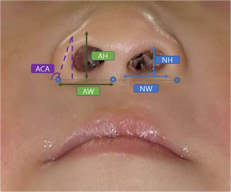 A New Technique For Perioral Muscle Reconstruction And Lip Lengthening