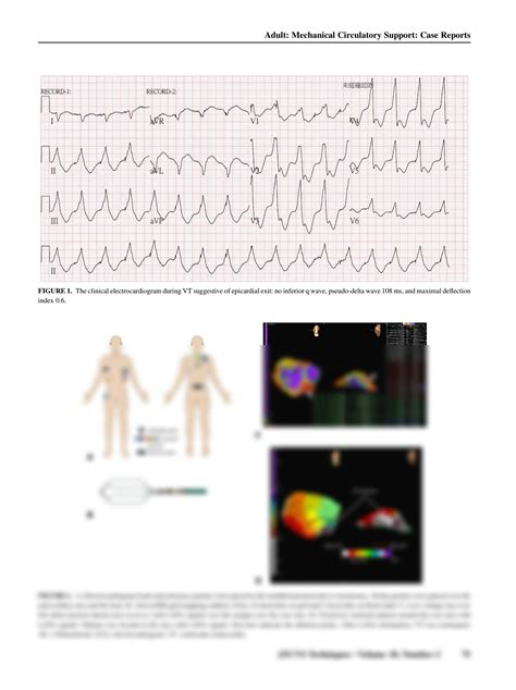 Solution Intraoperative Open Chest Epicardial High Density Mapping And