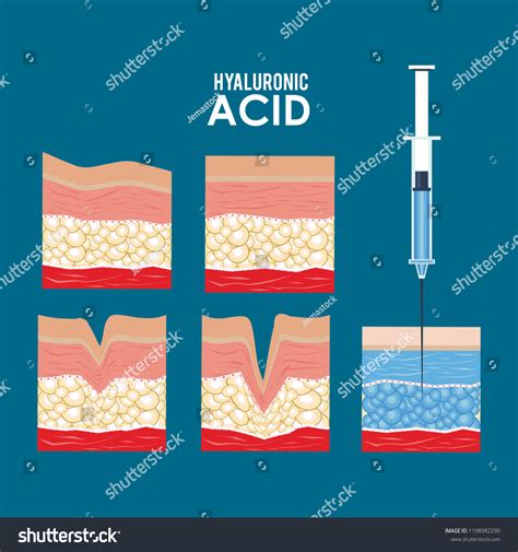 Hyaluronic Acid Filler Injection Infographic Stock Vector (Royalty Free