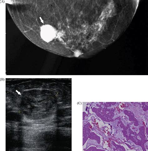 Imaging Findings In Mucinous Breast Carcinoma And Correlating Factors