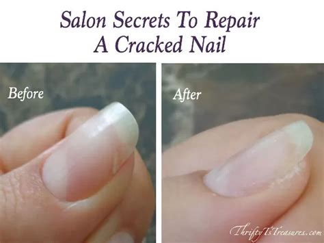 how to fix a cracked nail bed
