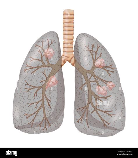 Bronchitis Lung Hi Res Stock Photography And Images Alamy