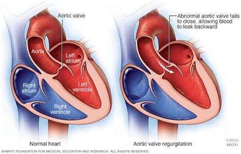 Aortic Valve Disease Disease Reference Guide