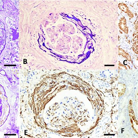 Many Glomeruli Had Fibrocellular Crescents There Was Extensive