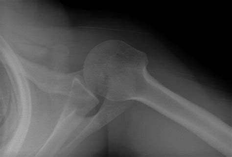 Axillary Radiograph Showing The Pathologic Coracoid Fracture Download Scientific Diagram