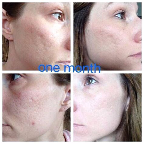 Do you have deep pock marks from acne scarring? Have you always thought you were just STUCK with ...