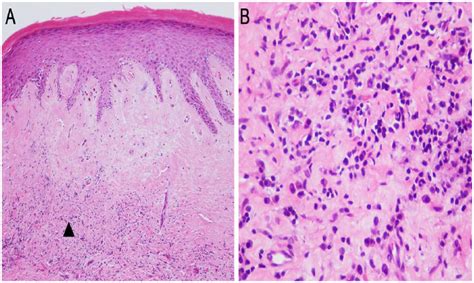 Balanitis Xerotica Obliterans Histology