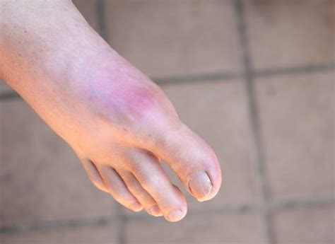 12 Signs Of Gout Facty Health
