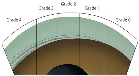 Gonioscopy Corneal Wedge