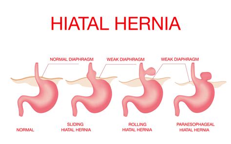 Hiatal Hernia - Dubai Hernia Surgery Clinic DRHC
