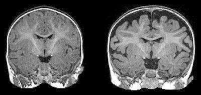 Increased Cerebrospinal Fluid Found in Infants with Autism | DW