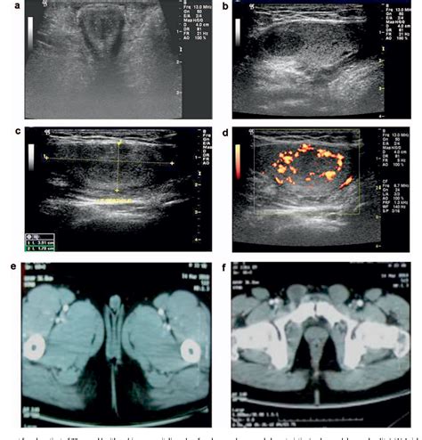 Ambiguous Genitalia Ultrasound