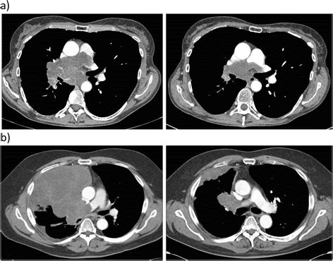 Presentation And Management Of Pulmonary Artery Sarcoma Clinical