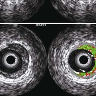 VH IVUS Analysis Of Plaque Behind The Stent Struts Color Coded Tissue