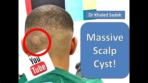 Massive Cyst Eruption LipomaCyst Dr Khaled Sadek YouTube