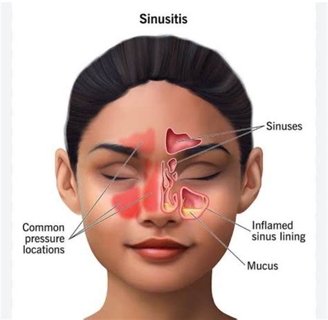 sinuses medizzy