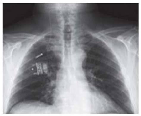 Figure 4 From Hypoglossal Nerve Stimulation In The Treatment Of