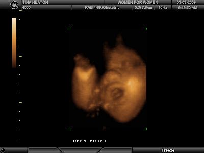 3d ultrasound 20 weeks boy