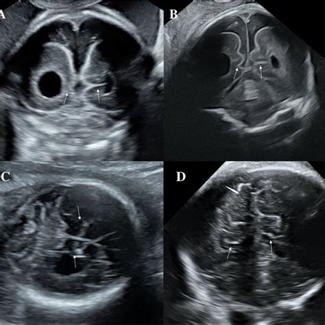 Asymmetry in the development and ‘catch-up growth’ of cingulate sulcus ...