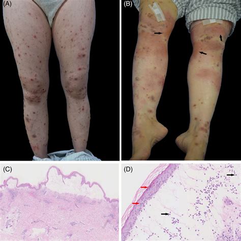 A Generalized Symmetrical Erythematous Papules And Nodules On The