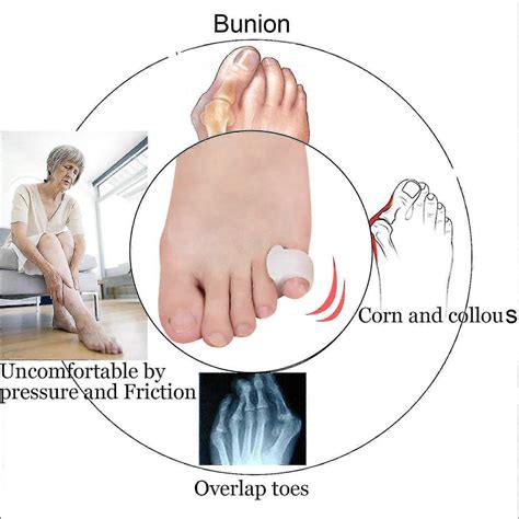 10pcs Pinky Toe Separator, Gel Toe Spacers Straightener, Hammer Toe