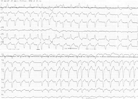 Paroxysmal Atrial Fibrillation