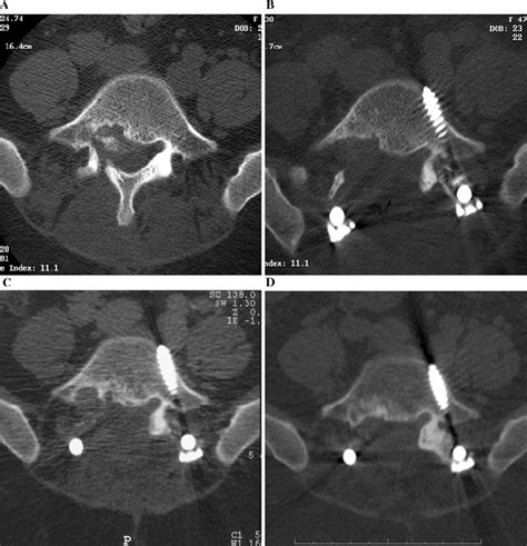 A Axial Ct Of A St Osteoblastoma Of L B Axial Ct Image Of The