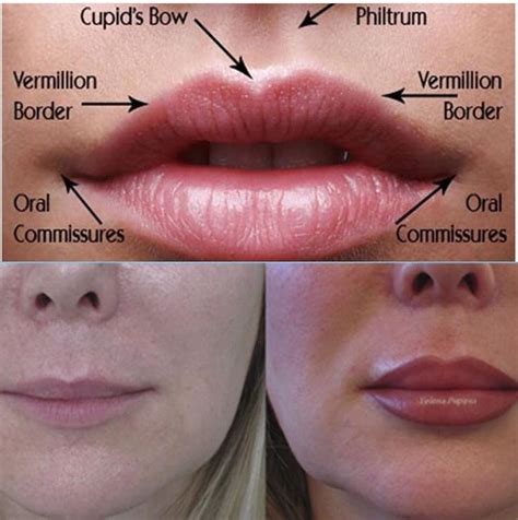 Lip Augmentation At Laser Clinique Lip Augmentation Dermal Fillers