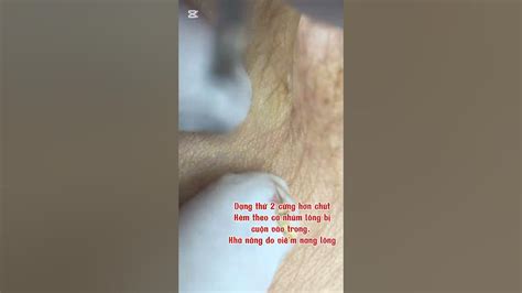 Part #960 Techniques For Acne — Severe Blackhead Removal - YouTube