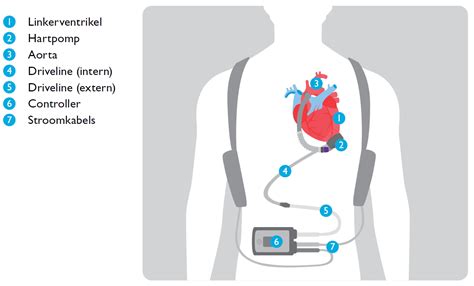lvad left ventricular assist device uz leuven