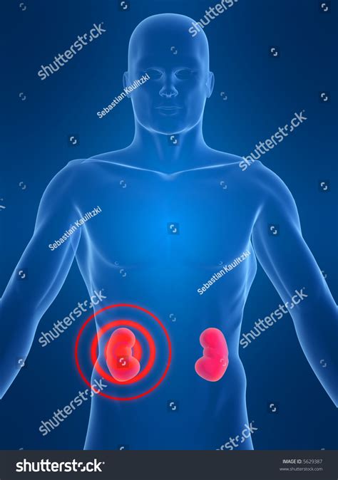 Kidney Inflammation Stock Photo 5629387 : Shutterstock