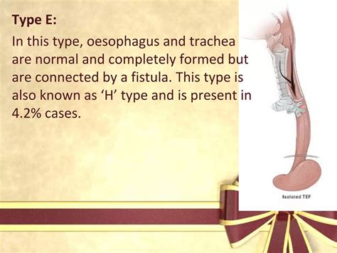 Tracheo Oesophageal Fistula Ppt