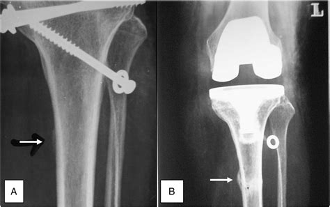 Total Knee Arthroplasty For Arthritic Knees With Tibiofibular Stress