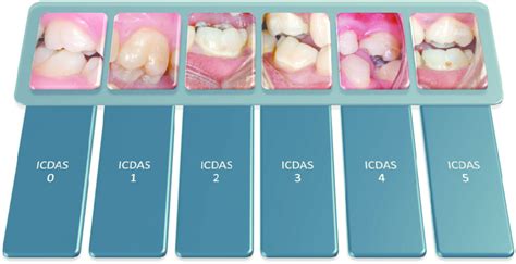 Icdas Caries Classification