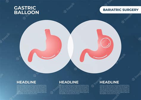 Balão gástrico de endoscopia de estômago dentro de uma cirurgia de ...