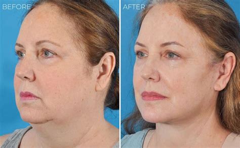 Neck Lift • Ponsky Facial Plastic Surgery