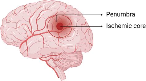 blood brain barrier breakdown  brain ischemia insights  mri