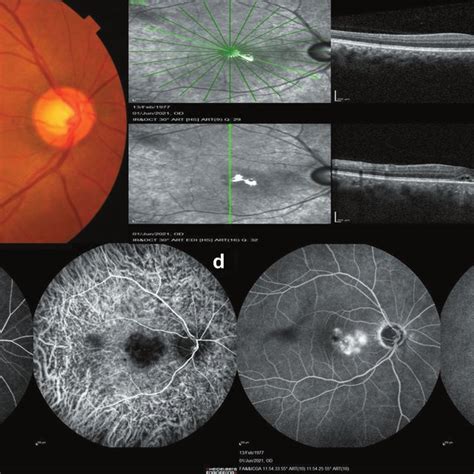 Multimodal Imaging Findings In A Patient With Acute Idiopathic