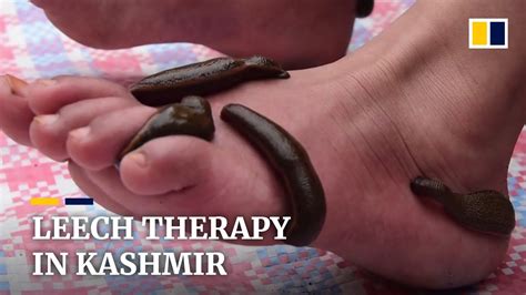 Kashmir Residents Seek Leech Therapy On Navroz Youtube