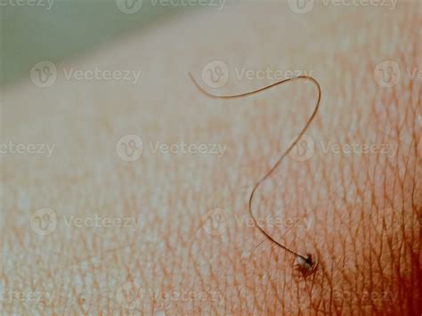 Mole birthmark nevus macro photo on human skin with hair. close up