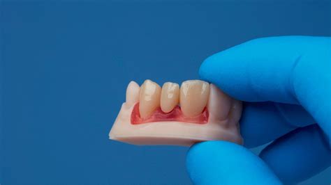 Model Resin Gets a Speed and Accuracy Upgrade | Formlabs Dental