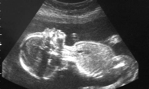 Hospitals Refuse To Tell Parents Sex Of Their Unborn Babies Because Staff Don T Have Time