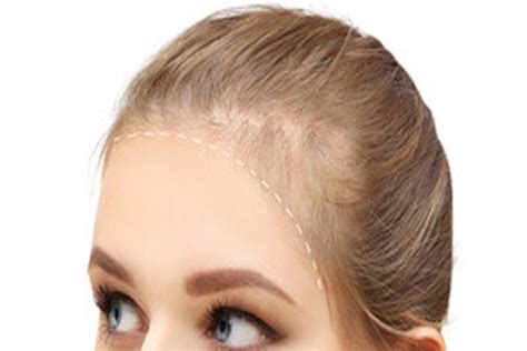 Frontal Fibrosing Alopecia What Are Its Causes Capilclinic