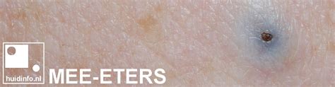 Mee Eters Huidinfonl Uitleg Van De Dermatoloog
